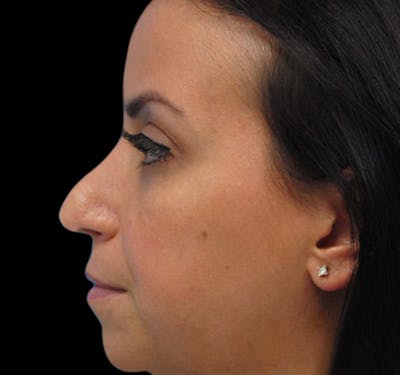 New Jersey Non-Surgical Rhinoplasty Before & After Gallery - Patient 55438566 - Image 1