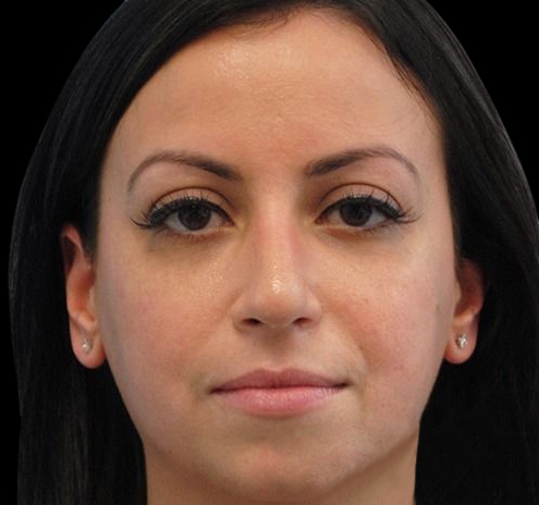 New Jersey Non-Surgical Rhinoplasty Before & After Gallery - Patient 55438566 - Image 4