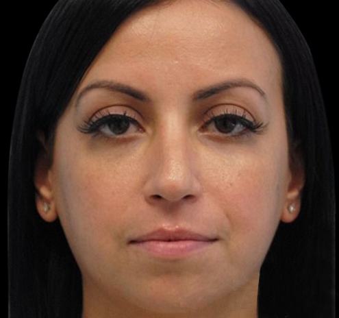 New Jersey Non-Surgical Rhinoplasty Before & After Gallery - Patient 55438566 - Image 3