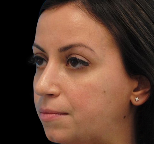 New Jersey Non-Surgical Rhinoplasty Before & After Gallery - Patient 55438566 - Image 6