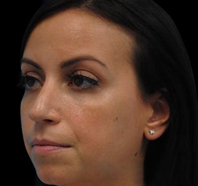 New Jersey Non-Surgical Rhinoplasty Before & After Gallery - Patient 55438566 - Image 5