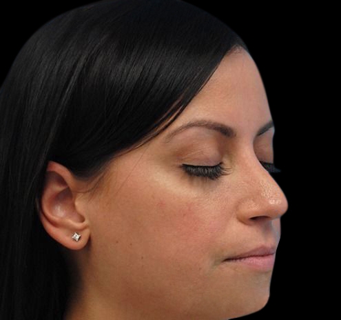 New Jersey Non-Surgical Rhinoplasty Before & After Gallery - Patient 55438566 - Image 7