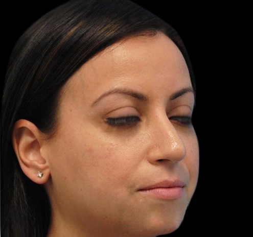 New Jersey Non-Surgical Rhinoplasty Before & After Gallery - Patient 55438566 - Image 8