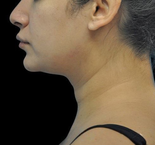 New Jersey Facial Liposuction Before & After Gallery - Patient 55438120 - Image 9