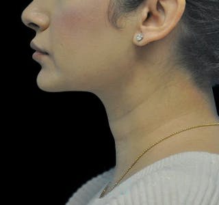 New Jersey Liposuction Before & After Gallery - Patient 55438120 - Image 10