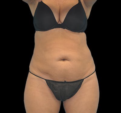 New Jersey Tummy Tuck Before & After Gallery - Patient 63743268 - Image 1