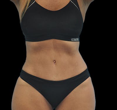 New Jersey Tummy Tuck Before & After Gallery - Patient 63743268 - Image 2