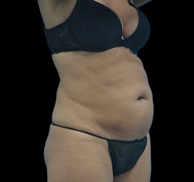 New Jersey Tummy Tuck Before & After Gallery - Patient 63743268 - Image 3