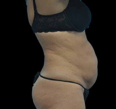 New Jersey Tummy Tuck Before & After Gallery - Patient 63743268 - Image 5