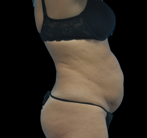 Tummy Tuck Before & After Gallery - Patient 63743268 - Image 5