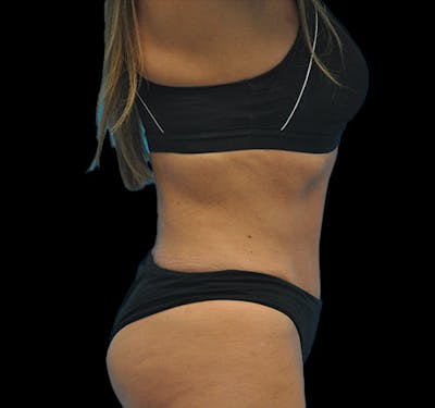 Tummy Tuck Before & After Gallery - Patient 63743268 - Image 6