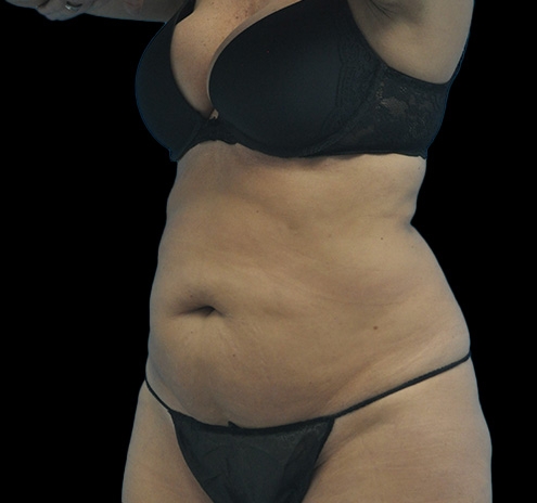 New Jersey Tummy Tuck Before & After Gallery - Patient 63743268 - Image 7