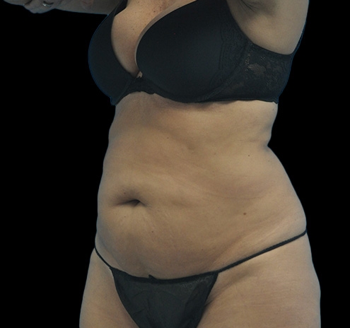 Tummy Tuck Before & After Gallery - Patient 63743268 - Image 7