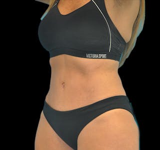 Tummy Tuck Before & After Gallery - Patient 63743268 - Image 8
