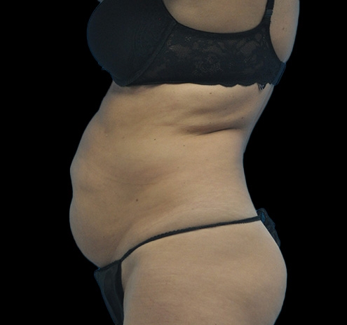 New Jersey Tummy Tuck Before & After Gallery - Patient 63743268 - Image 9