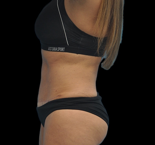 New Jersey Tummy Tuck Before & After Gallery - Patient 63743268 - Image 10