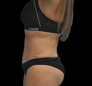 New Jersey Tummy Tuck Before & After Gallery - Patient 63743268 - Image 10