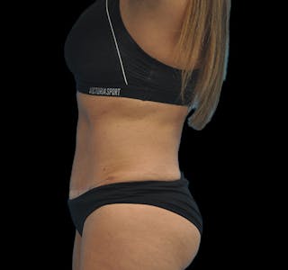 Tummy Tuck Before & After Gallery - Patient 63743268 - Image 10