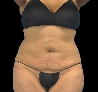 New Jersey Tummy Tuck Before & After Gallery - Patient 63743267 - Image 1