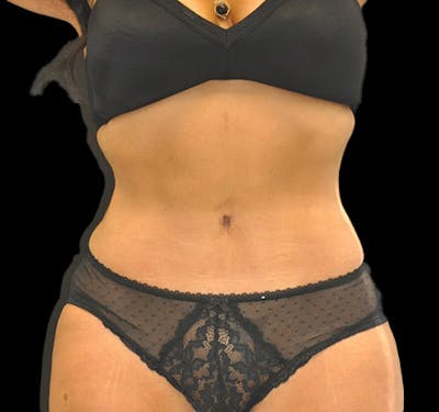 New Jersey Tummy Tuck Before & After Gallery - Patient 63743267 - Image 2