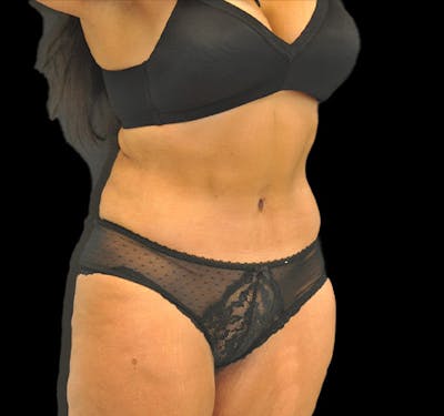 New Jersey Tummy Tuck Before & After Gallery - Patient 63743267 - Image 4