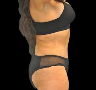 Tummy Tuck Before & After Gallery - Patient 63743267 - Image 6