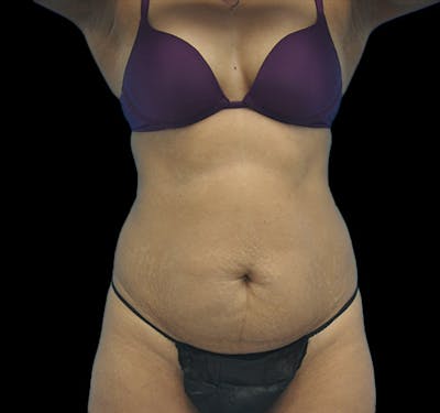 New Jersey Tummy Tuck Before & After Gallery - Patient 63743266 - Image 1