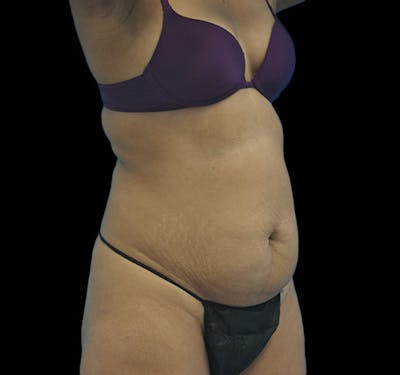 New Jersey Tummy Tuck Before & After Gallery - Patient 63743266 - Image 3