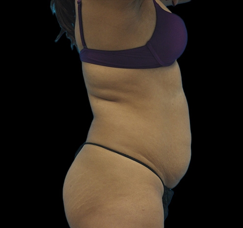 Tummy Tuck Before & After Gallery - Patient 63743266 - Image 5