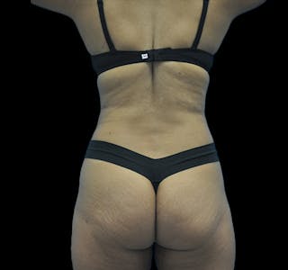 Tummy Tuck Before & After Gallery - Patient 63743266 - Image 8