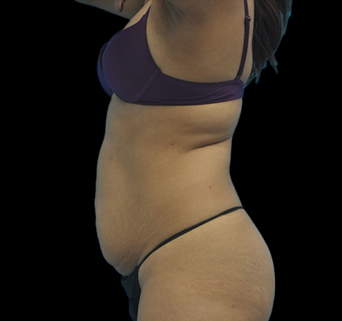 New Jersey Tummy Tuck Before & After Gallery - Patient 63743266 - Image 11