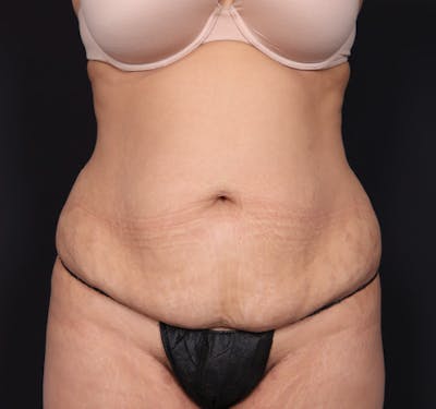 New Jersey Tummy Tuck Before & After Gallery - Patient 63839769 - Image 1