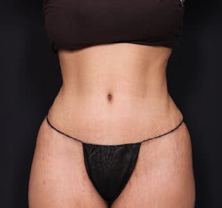 Tummy Tuck Before & After Gallery - Patient 63839769 - Image 2