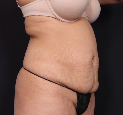 New Jersey Tummy Tuck Before & After Gallery - Patient 63839769 - Image 3
