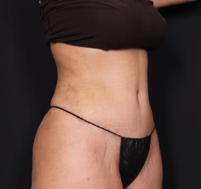 New Jersey Tummy Tuck Before & After Gallery - Patient 63839769 - Image 4
