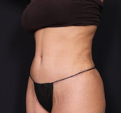 New Jersey Tummy Tuck Before & After Gallery - Patient 63839769 - Image 6