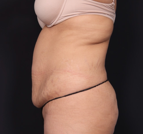 New Jersey Tummy Tuck Before & After Gallery - Patient 63839769 - Image 7