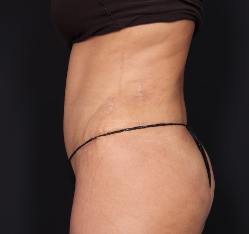 New Jersey Tummy Tuck Before & After Gallery - Patient 63839769 - Image 8