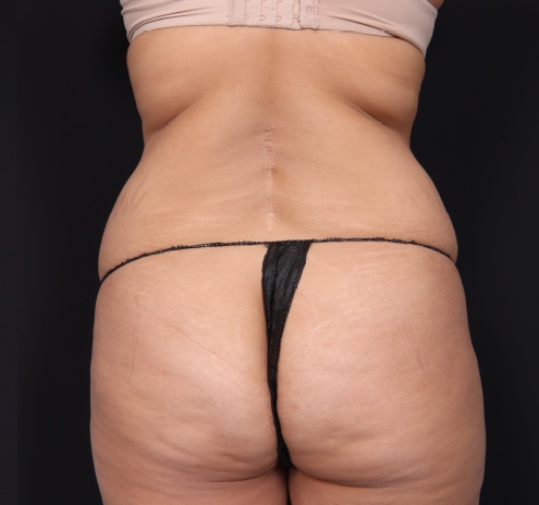 New Jersey Tummy Tuck Before & After Gallery - Patient 63839769 - Image 9