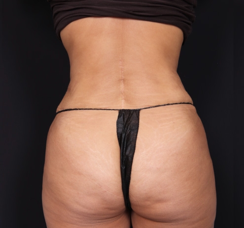 New Jersey Tummy Tuck Before & After Gallery - Patient 63839769 - Image 10