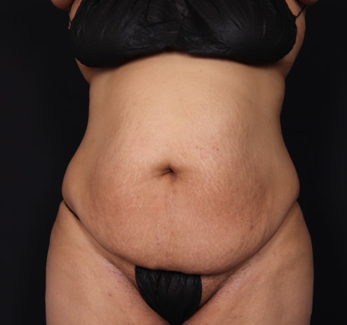 New Jersey Tummy Tuck Before & After Gallery - Patient 63839771 - Image 1