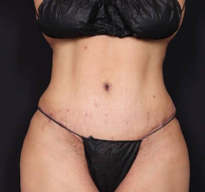 New Jersey Tummy Tuck Before & After Gallery - Patient 63839771 - Image 2
