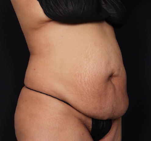 New Jersey Tummy Tuck Before & After Gallery - Patient 63839771 - Image 3