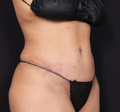 New Jersey Tummy Tuck Before & After Gallery - Patient 63839771 - Image 4