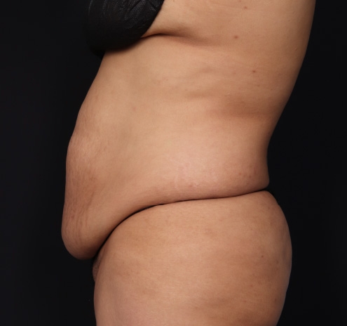New Jersey Tummy Tuck Before & After Gallery - Patient 63839771 - Image 7