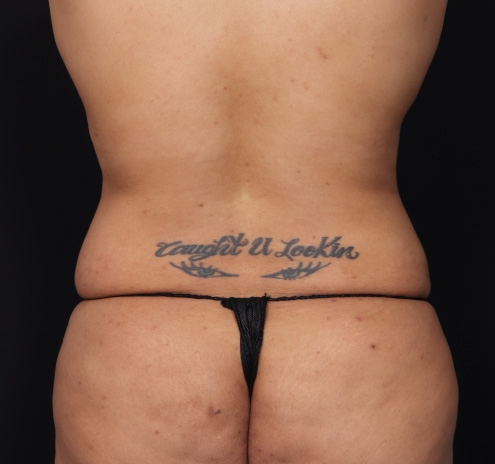New Jersey Tummy Tuck Before & After Gallery - Patient 63839771 - Image 9