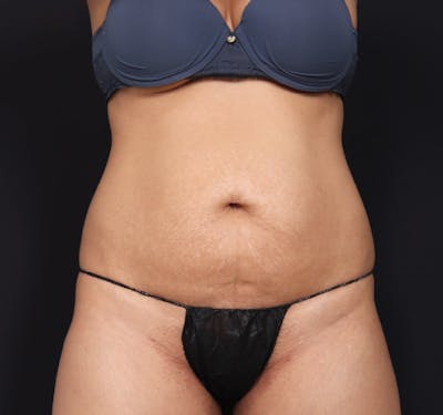 New Jersey Tummy Tuck Before & After Gallery - Patient 63839778 - Image 1