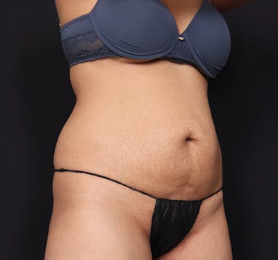 New Jersey Tummy Tuck Before & After Gallery - Patient 63839778 - Image 3