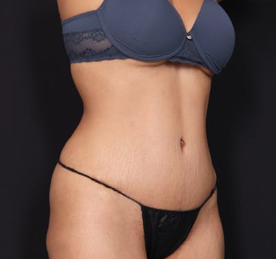 Tummy Tuck Before & After Gallery - Patient 63839778 - Image 4