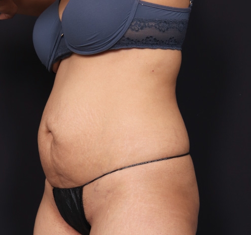 New Jersey Tummy Tuck Before & After Gallery - Patient 63839778 - Image 5